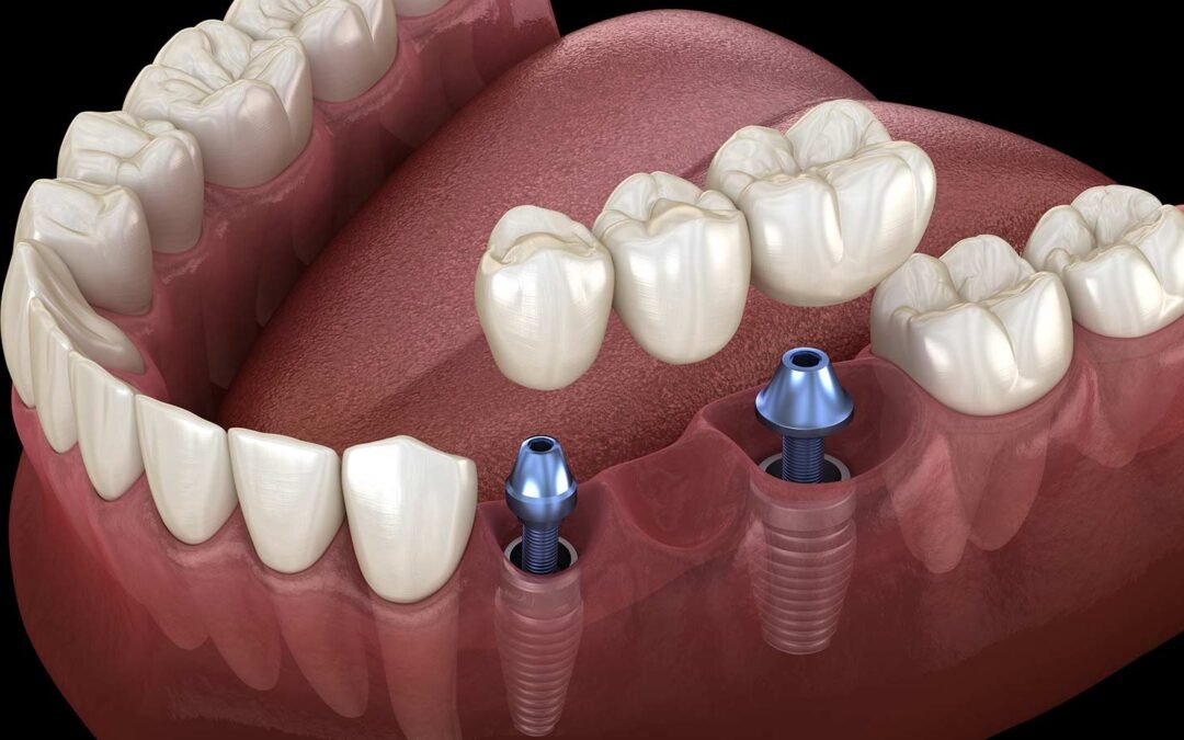 Igiena după Implant Dentar – Ghid Complet 2026