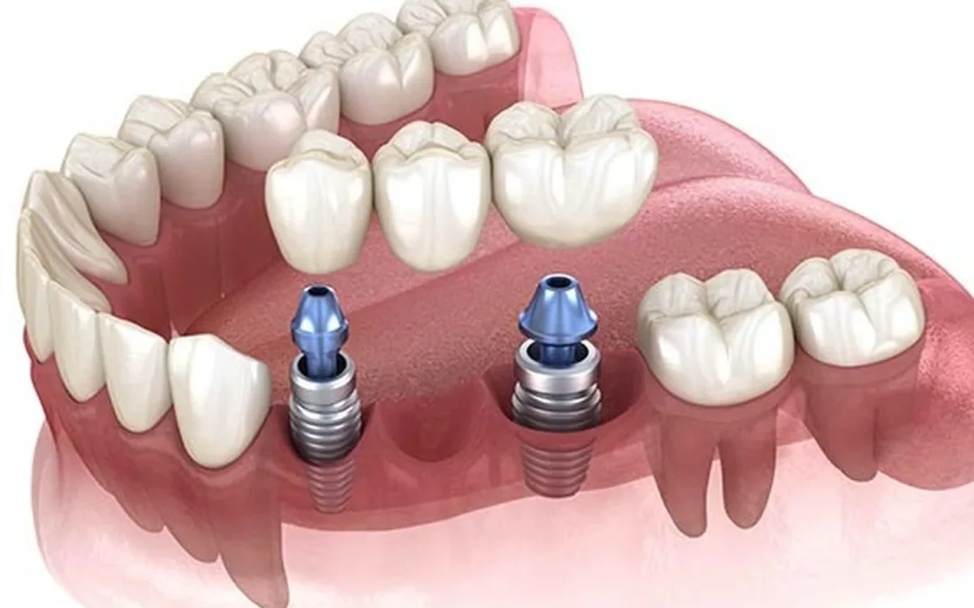 Durata de Viață pentru un Implant Dentar – 2026